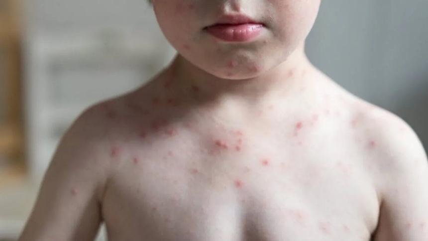 En Weston, Florida (EEUU), la comunidad escolar de la Escuela Primaria Country Isles ha sido alertada sobre un caso confirmado de tosferina, una enfermedad respiratoria altamente contagiosa.  