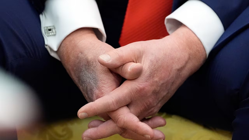 Mano amoratada del presidente de EEUU, Donald Trump / Cortesía